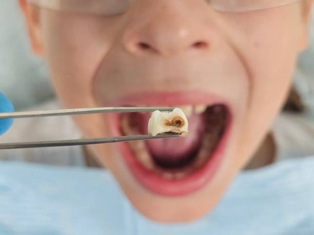 Best Pediatric Emergency Dentist in Cedar Grove, WI